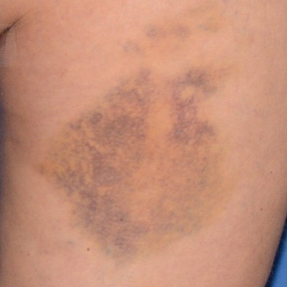 Day 8 with Replasty Age Recovery Body