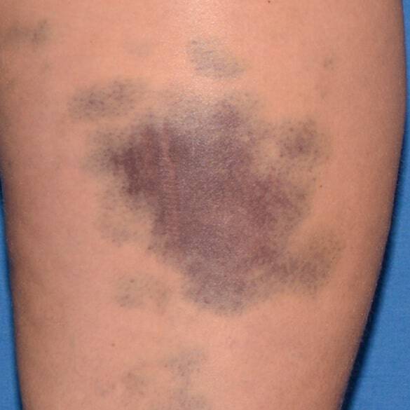 Day 8 with reference cream