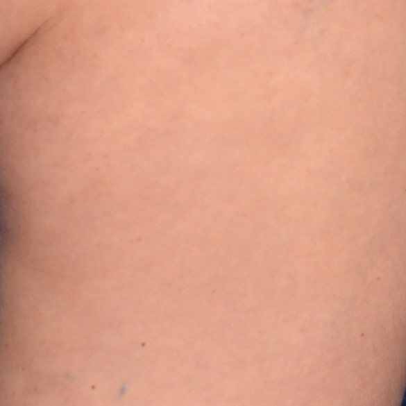 Day 28 with Replasty Age Recovery Body