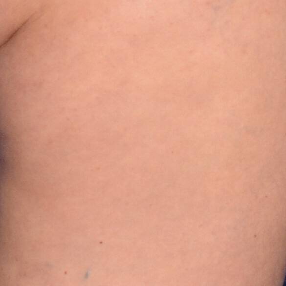 Day 28 with Replasty Age Recovery Body