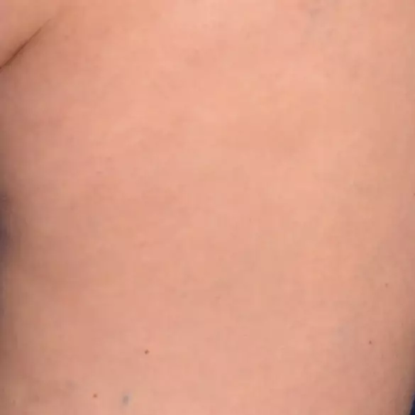 Day 28 with Replasty Age Recovery Body