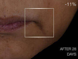 Close-up of skin before treatment, showing visible nasolabial folds and signs of aging around the mouth.