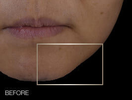 Helena Rubinstein: -14% reduction in lower face ptosis after 28 days, revealing a more defined jawline.