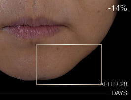 Close-up of lower face before treatment, showing signs of skin laxity and lack of definition around the jawline.