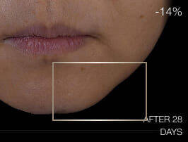 Close-up of lower face before treatment, showing signs of skin laxity and lack of definition around the jawline.