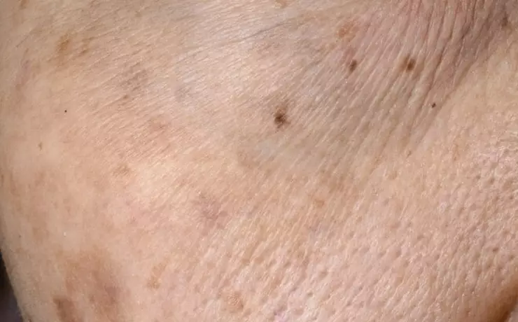 After 42 days Image